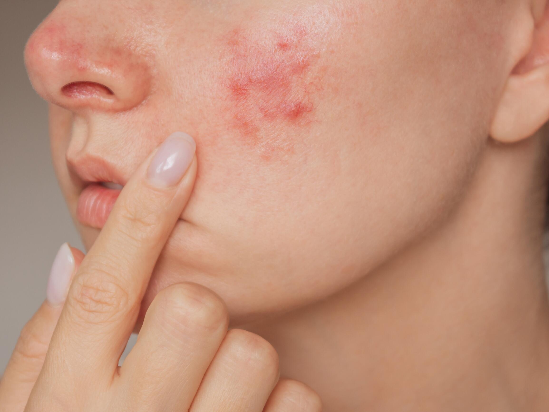 sintomi dell’eczema
